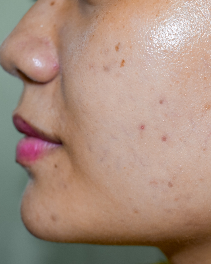 centre cleo 33 taches brunes melasma