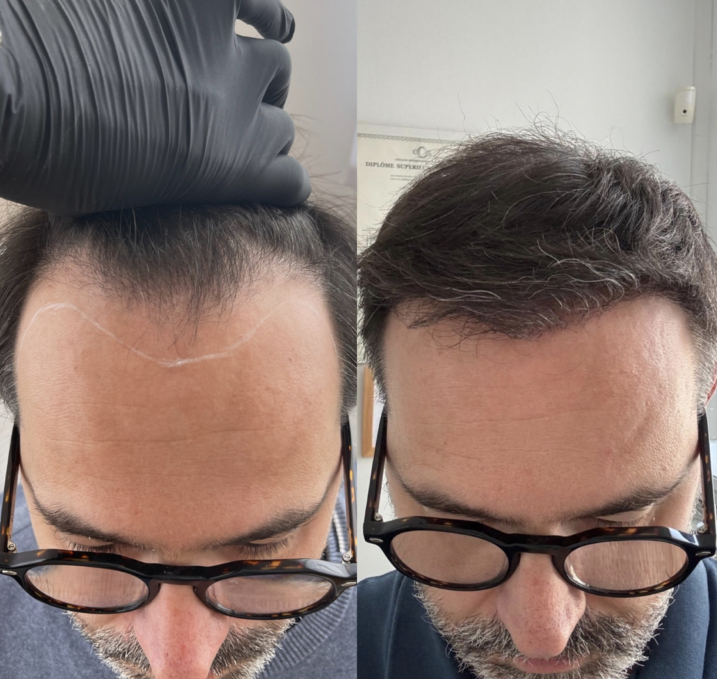 Greffe capillaire FUE Bordeaux 5 avant apres 6mois