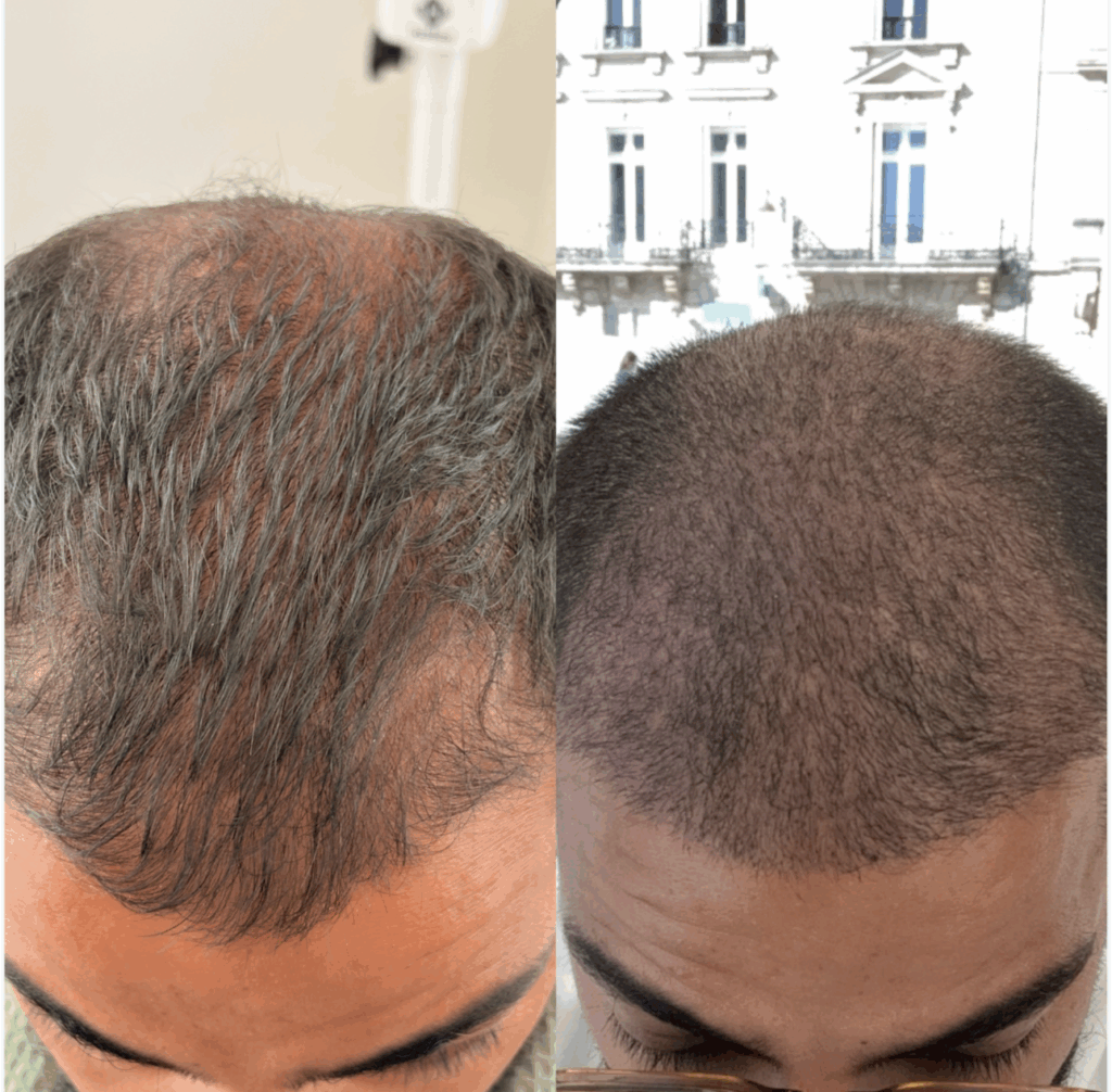 Greffe capillaire FUE Bordeaux 3 capture decran . 2025 10 08 a 10.15.48