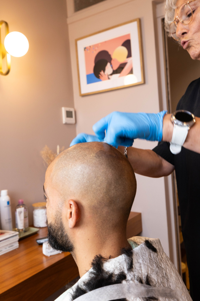 Greffe capillaire FUE Bordeaux 7 greffe 12