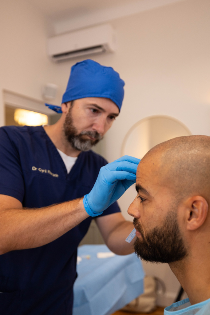 Greffe capillaire FUE Bordeaux 8 greffe 30