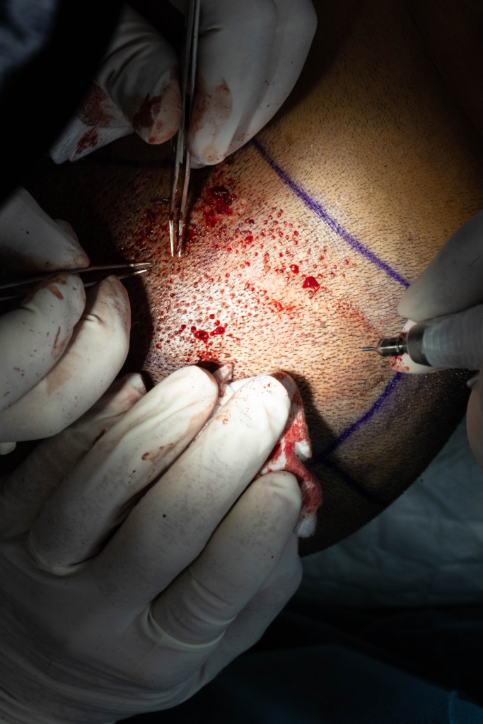 Greffe capillaire FUE Bordeaux 11 greffe 94