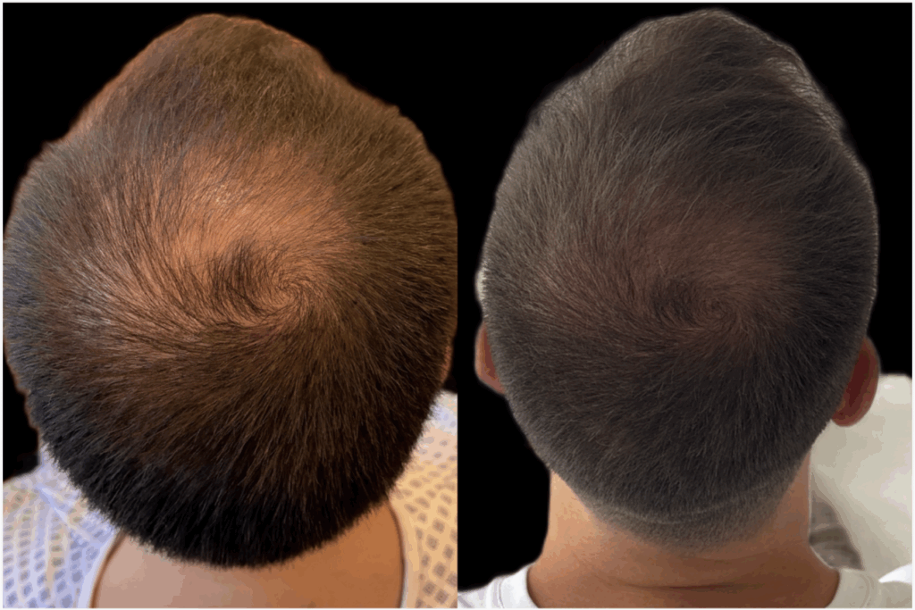 Greffe de cheveux à Bordeaux (FUE) – CLEO Hair Clinic 5 4moisvertex