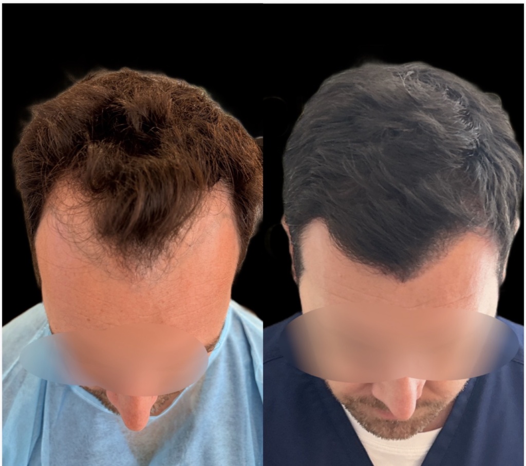 Greffe de cheveux à Bordeaux (FUE) – CLEO Hair Clinic 8 img 0886