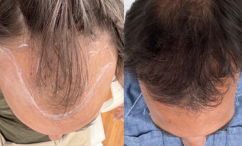 Greffe de cheveux à Bordeaux (FUE) – CLEO Hair Clinic 7 img 1167